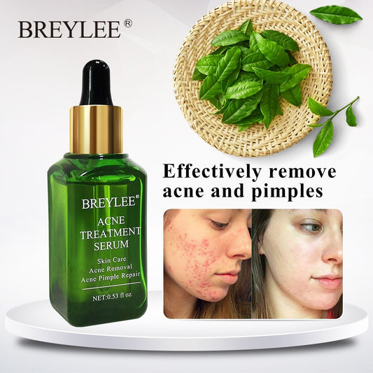 Acne Treatment Serum - Skin Repair